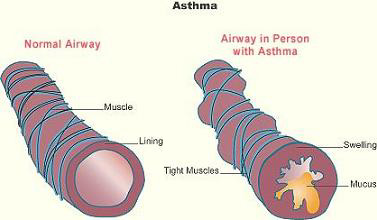 Air Passages Illustration, Healthy versus Restricted