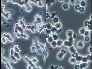 Blood Cells Before and After Subject Consumed Water Treated with the Stir Wand - Photo 2