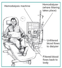 Drawing of a man receiving hemodialysis treatment. Labels point to the hemodialyzer, where filtering takes place; hemodialysis machine; a tube where unfiltered blood flows to the dialyzer; and a tube where filtered blood flows back to the patient?s body.