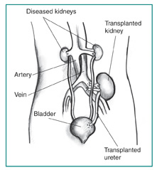 Anatomical diagram of a female figure with a transplanted kidney. The two diseased kidneys are still in place on either side of the spine, just below the rib cage. The transplanted kidney is located on the left side, just above the bladder. A transplanted ureter connects the new kidney to the bladder. Labels point to the diseased kidneys, artery, vein, transplanted kidney, transplanted ureter, and bladder.