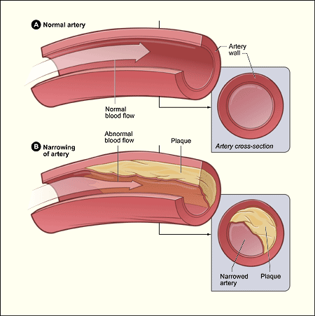 High Blood Pressure Monitoring