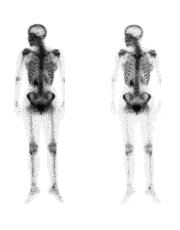 Bone Scans