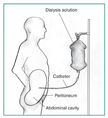 Diagram of a patient receiving continuous ambulatory peritoneal dialysis. Labels point to the dialysis solution, catheter, peritoneum, and abdominal cavity.