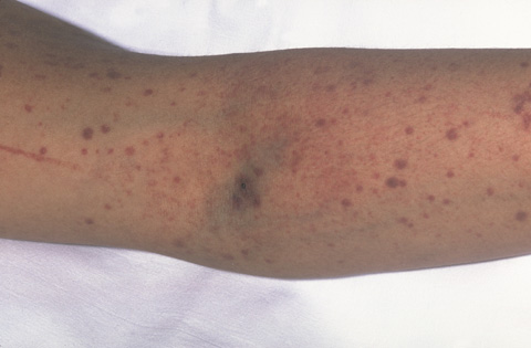 The photograph shows petechiae (red/purple dots) and purpura (bruises) in the skin. Bleeding under the skin causes the purple, brown, and red color of the petechiae and purpura.