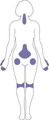 Outline of a woman highlighting neck, spine, hips, fingers, and knees to show common locations of osteoarthritis