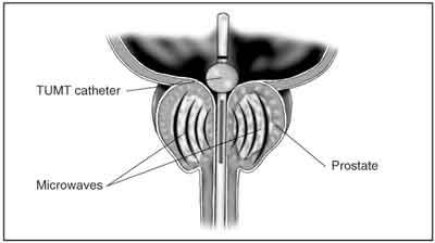 Cross-section diagram of the prostate, bladder, and urethra. A transurethral microwave thermotherapy (TUMT) catheter is in the urethra. The catheter extends all the way into the bladder. A small inflated ball near the end of the catheter keeps the catheter in place. Curved lines representing microwaves emanate from the catheter and travel through the prostate. Labels point to the TUMT catheter, microwaves, and prostate.