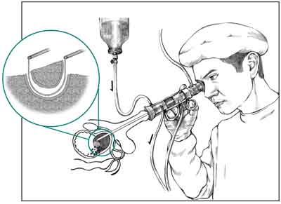 Drawing of a doctor performing a transurethral resection of a prostate. An inset shows a microscopic view of a wire loop cutting tissue from the prostate.